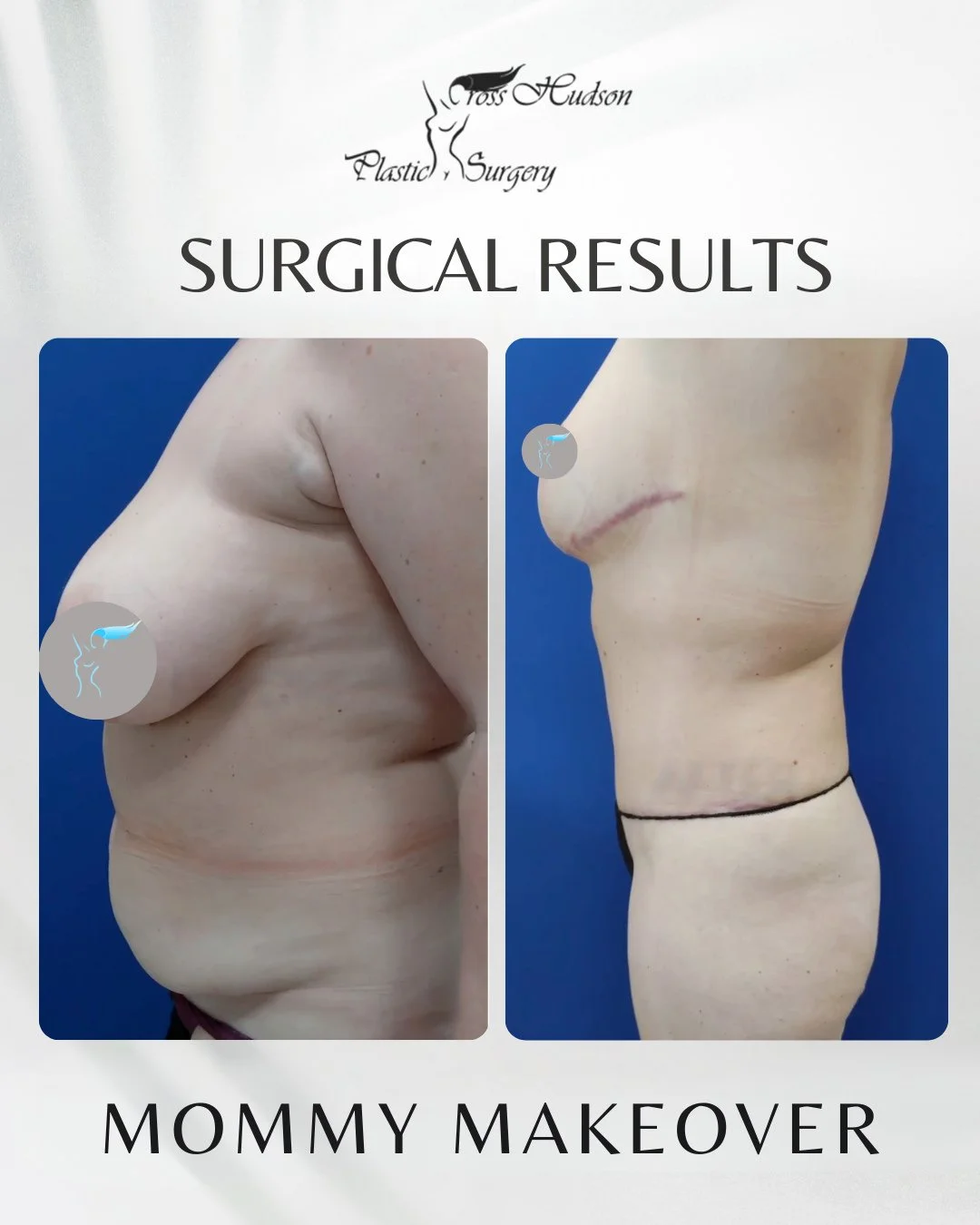Before and after liposuction results showing torso contouring from Cross Hudson Plastic Surgery